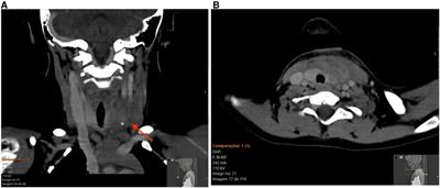 Case report: Fourth branchial cleft cyst: a case of acute suppurative thyroiditis